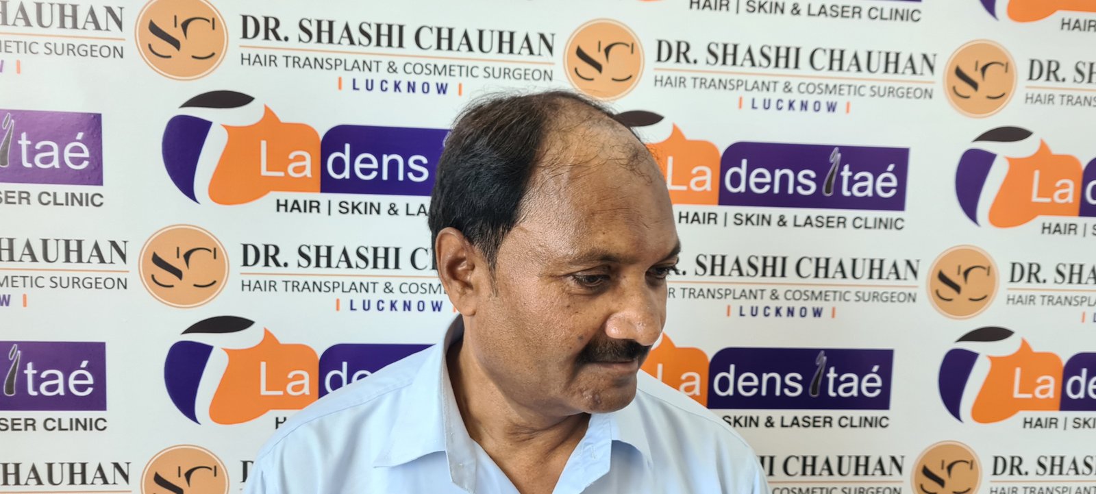 AK Singh Before Hair Transplant